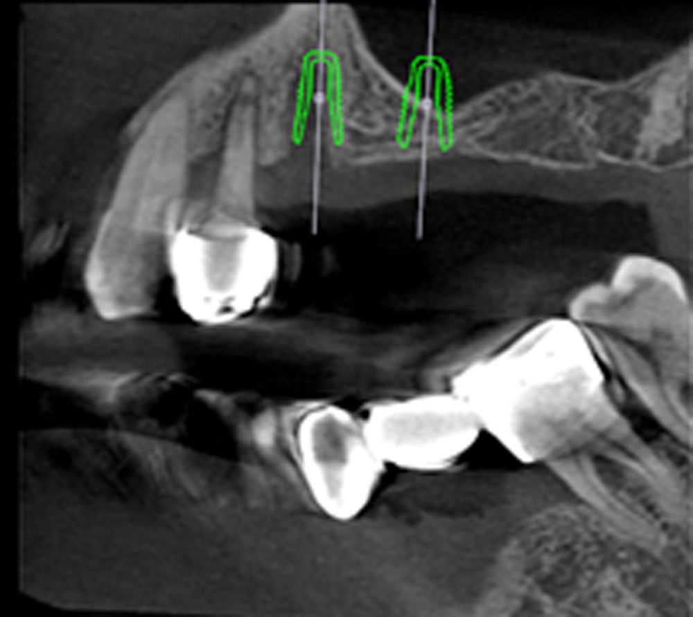 術前利用3D斷層掃描做精準規劃-蒔雨牙醫診所