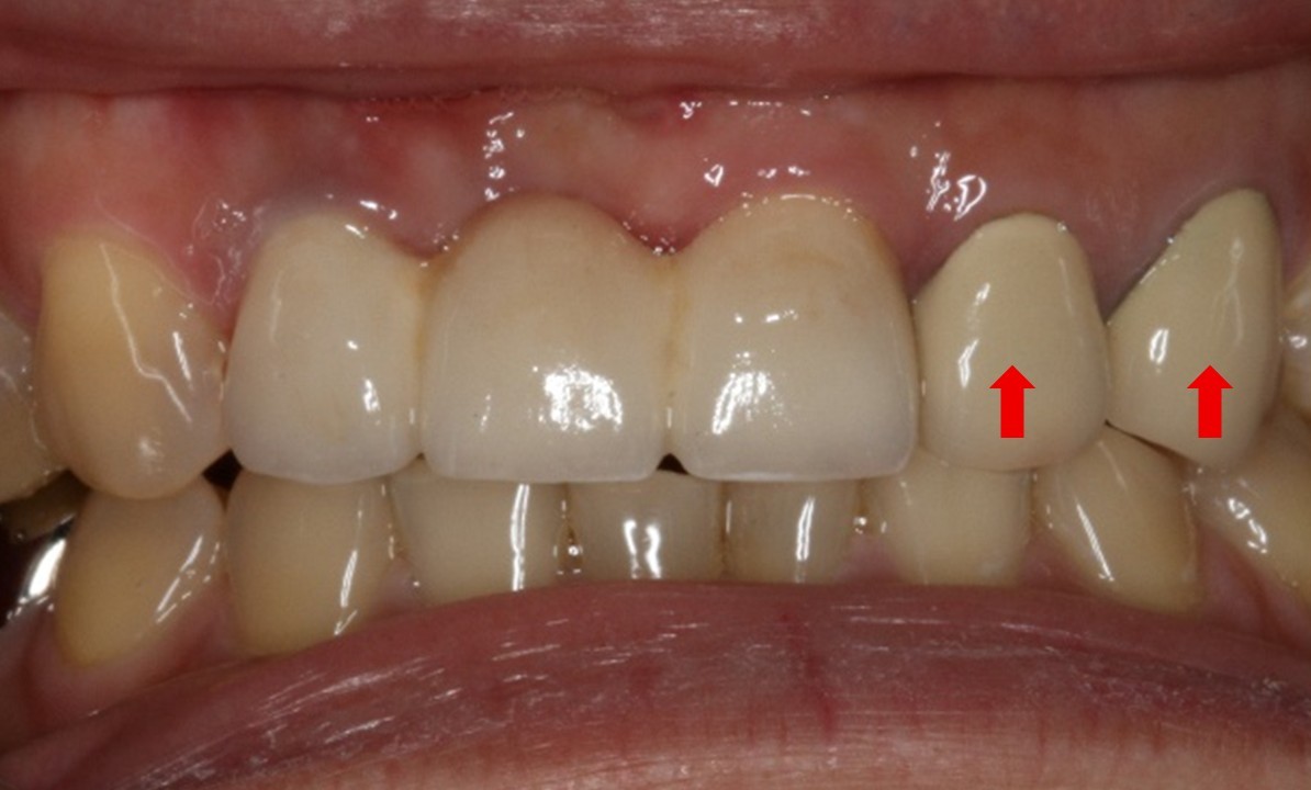 為了遮金屬色而顯得死白不透光-蒔雨牙醫診所