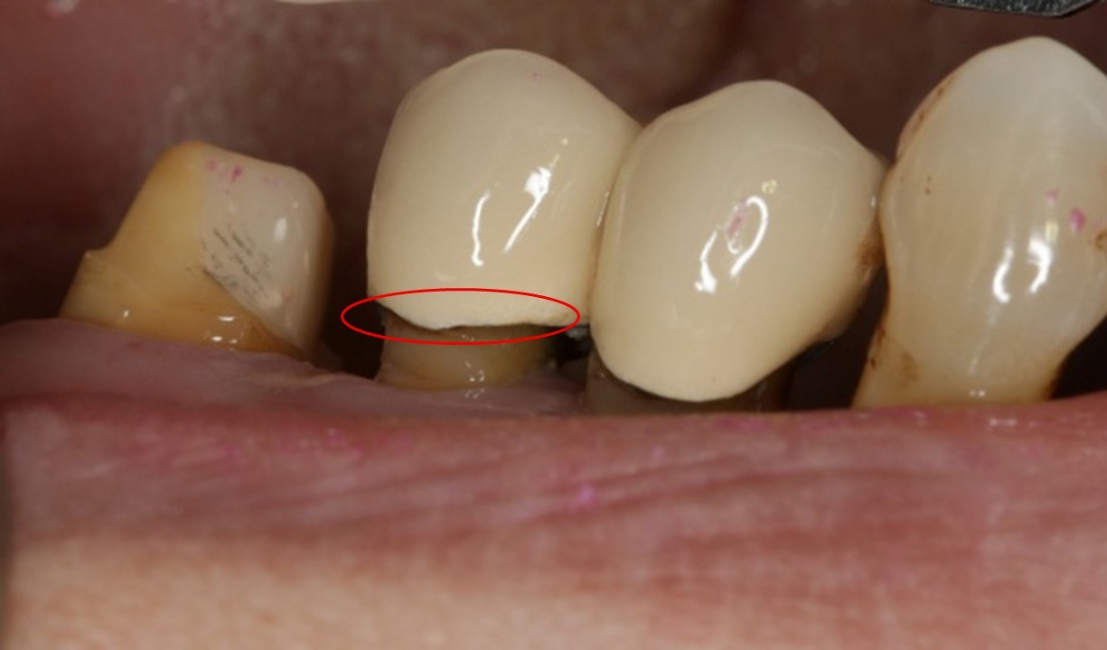 因牙齦萎縮而露出金屬邊緣的黑線-蒔雨牙醫診所
