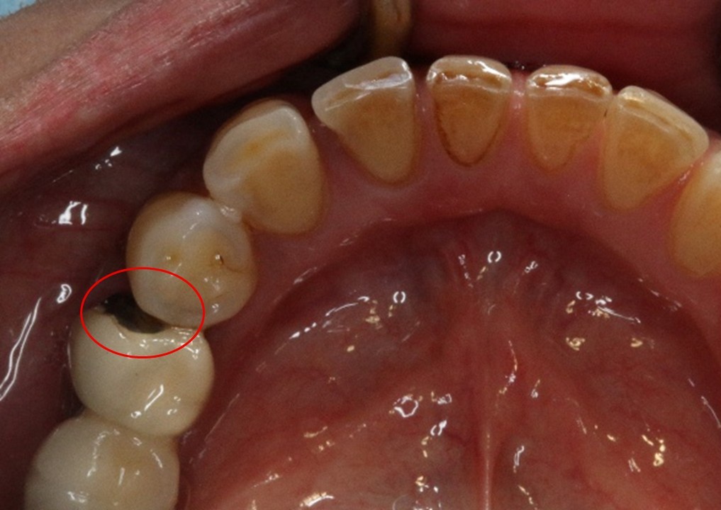 瓷崩-蒔雨牙醫診所