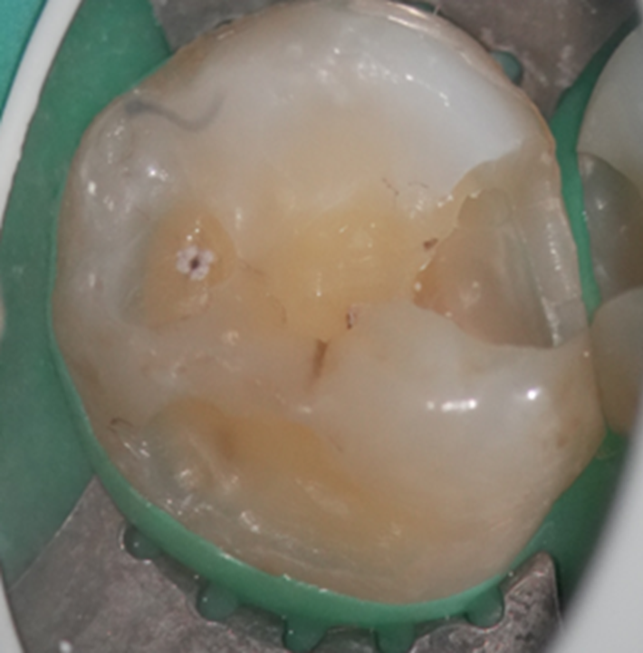 大範圍的齒質缺損-蒔雨牙醫診所