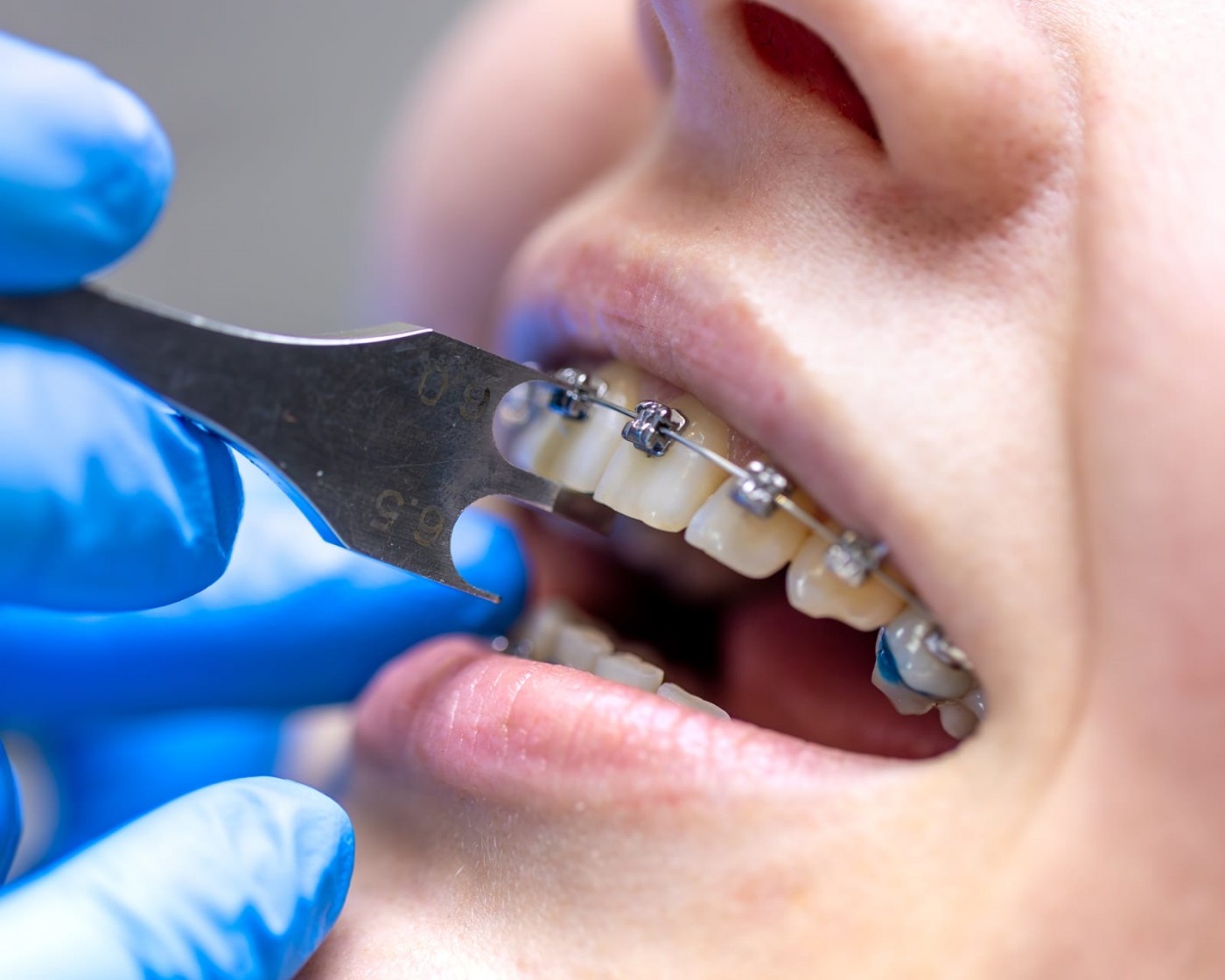 齒顎矯正-蒔雨牙醫診所