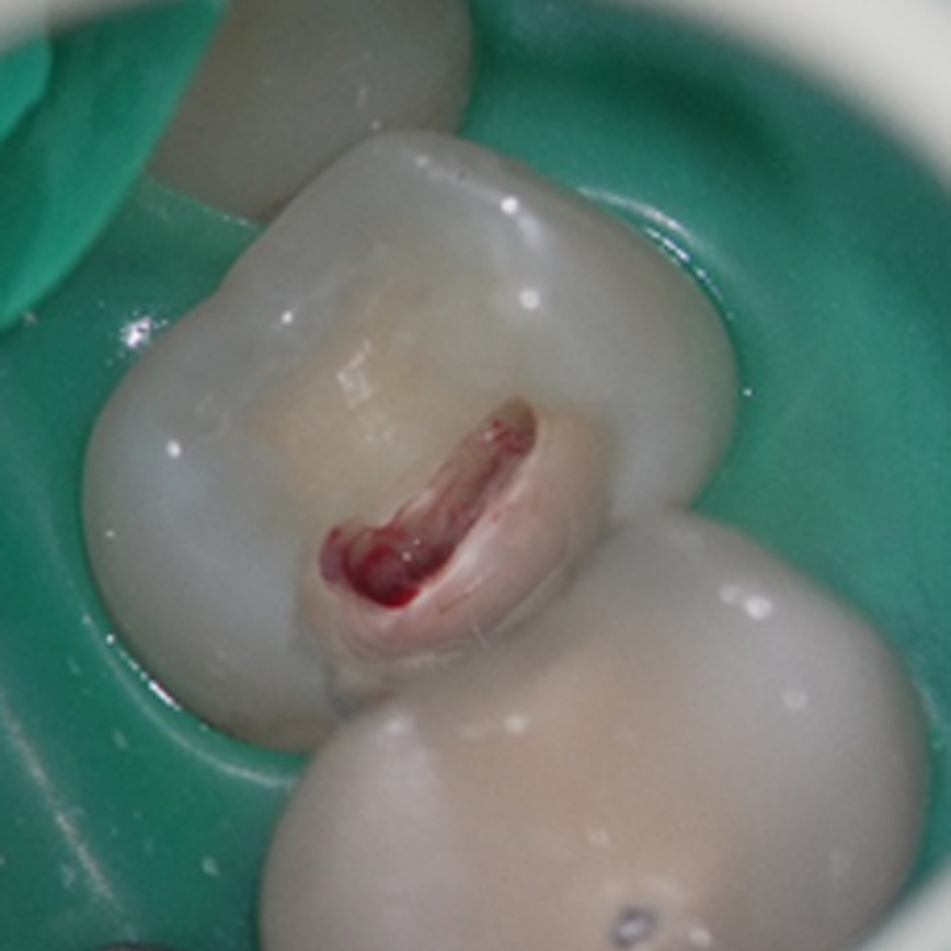 牙髓暴露但尚有健康活髓