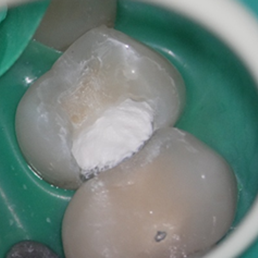 放置生物陶瓷材料活髓治療