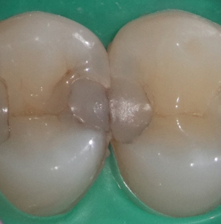 大範圍的齒質缺損-蒔雨牙醫診所