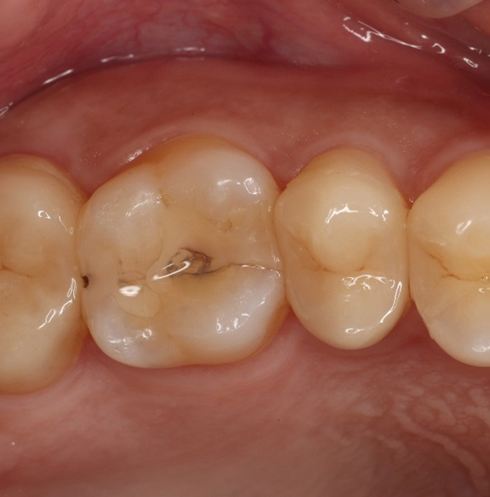 利用嵌體進行修復-蒔雨牙醫診所